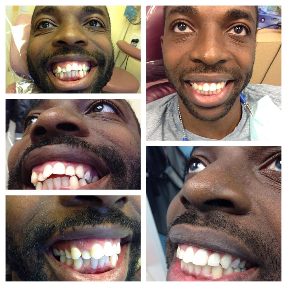 Before &  After Photos of Treatments at Advanced Dental Care of NYC